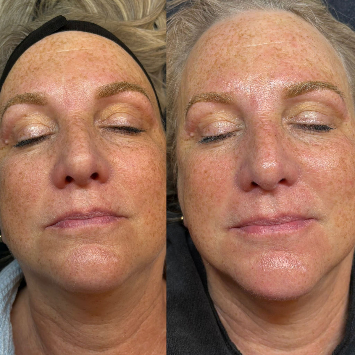 Before and after results