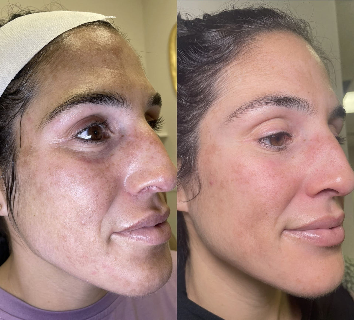 Before and after results